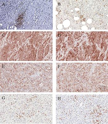 High TIL, HLA, and Immune Checkpoint Expression in Conventional High-Grade and Dedifferentiated Chondrosarcoma and Poor Clinical Course of the Disease